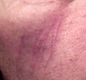 facial scars