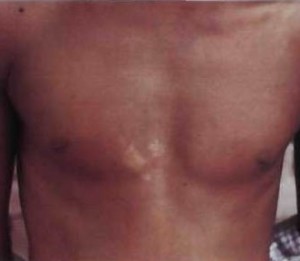 Photo of Hanumant's chest